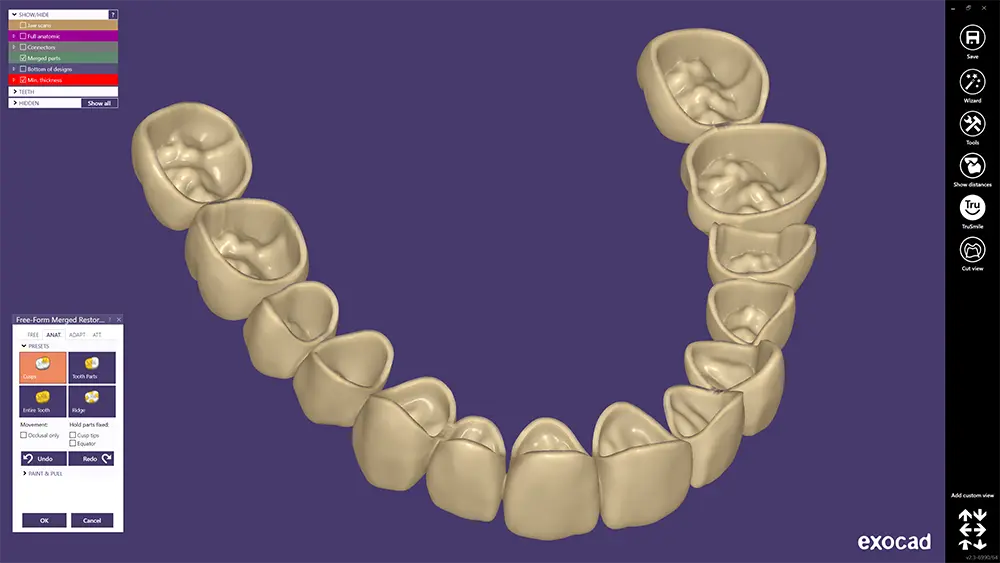 exocad DentalCAD Provisional Module - Flex