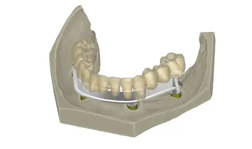 [AOMBM-P] exocad DentalCAD Bar Module - Perpetual